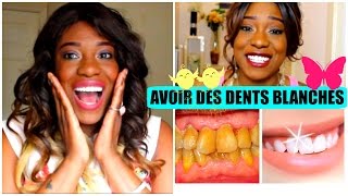 DENTS BLANCHES JE VOUS AI MENTI  Blanchiment facettes astuces [upl. by Flory]