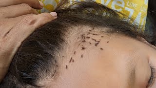 Head lice removing from brown hair  How to clear out all head lice [upl. by Daney]