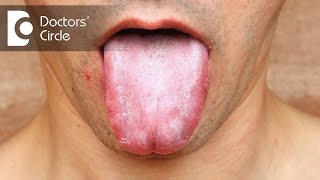 Is Oral Candidiasis related to HIV status  Dr Mohammed Fayaz Pasha [upl. by Notwen]