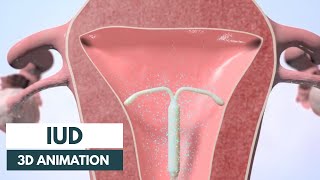 How does an IUD work  3D animation [upl. by Faust]