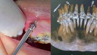 IZC screw Infra Zygomatic Crest insertion with CBCT 3D screening orthodontic mini implant short [upl. by Ahsinnod145]