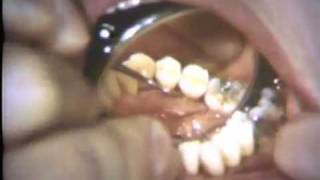 Subgingival Curettage [upl. by Chadd681]