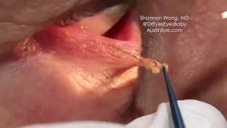 Excision of eyelid papilloma 91216 Shannon Wong MD [upl. by Katherine81]