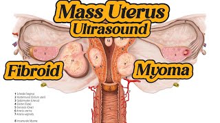 Uterus  Fibroid  Myoma  Mass On Ultrasound [upl. by Eissen]