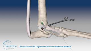 Ricostruzione del Legamento Tarsale Collaterale Mediale con NOVALIG [upl. by Tice]