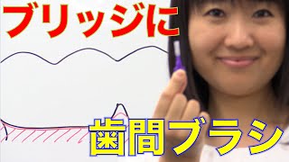 ブリッジの人は歯間ブラシを！ 口腔ケアチャンネル 493（口腔ケアチャンネル2 ＃166） [upl. by Alrak606]