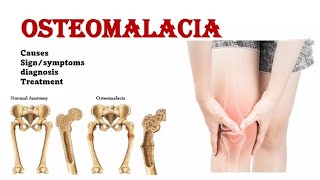 Osteomalacia  Rickets  Osteomalacia vs Osteoporosis  sign amp symptoms  management [upl. by Nerrad]