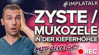 Zyste  Mukozele in der Kieferhöhle 🆘 Was tun Wir erklären die Ursachen amp Therapie inkl Live OP [upl. by Eam560]