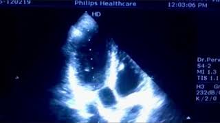 Discrete membranous subaortic stenosis [upl. by Noryk326]