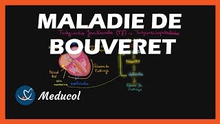 Tachycardie de Bouveret Tachycardie Jonctionnelle causes symptômes ECG et traitements [upl. by Nivrac]