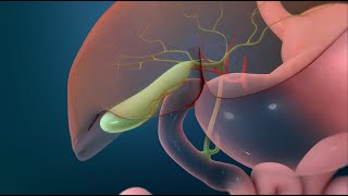 Surgery to Remove Your Gallbladder Open Cholecystectomy [upl. by Cassil]