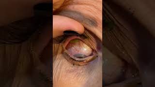 Doctor Removes 23 Contact Lenses From Patients Eye [upl. by Riabuz223]