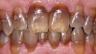 Tetracycline Stained Teeth Under 1 Minute By A DENTIST [upl. by Ilah166]