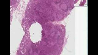 Histopathology Lymph nodeToxoplasmosis [upl. by Lang]