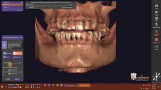 exoplan v30 Galway  Defining CT Densities [upl. by Yeorgi]