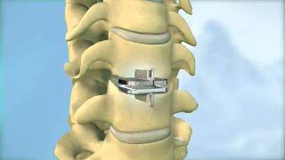 Disc replacement surgery for the neck [upl. by Lerim550]