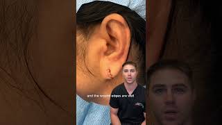 Earlobe repair transformation [upl. by Rabassa]