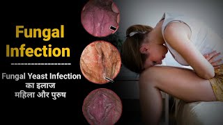 fungal infection private part treatment medicine for ringworm [upl. by Spaulding931]