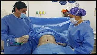 Cirugía Abdominal Abdominoplastia con Lipoescultura [upl. by Elletnahs]