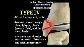 Salter Harris Fracture Classification  Everything You Need To Know  Dr Nabil Ebraheim [upl. by Ecirtaemed]