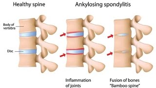 Ankylosing Spondylitis [upl. by Oicneconi]