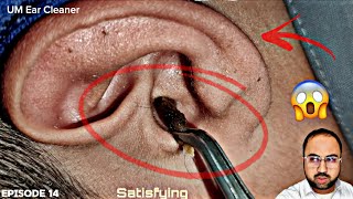 Really Big Ear wax Removal  Ear Cleaning  earwaxremoval  Episode 14 [upl. by Cawley]