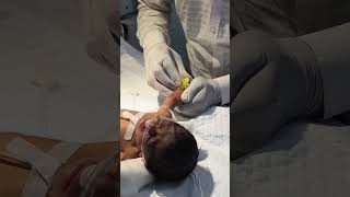 Newborn baby being cannulated youtubeshorts nursing sumitnicunursingstm newbornbaby cannula [upl. by Lobiv]