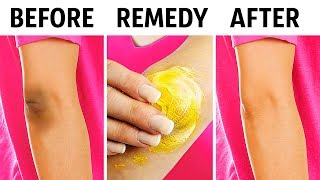 10 Natural Tricks to Remove Dark Knees and Elbows [upl. by Annuaerb842]