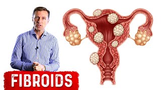 The Best Foods to Shrink Fibroids [upl. by Ayekan]