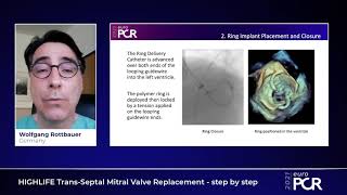 HIGHLIFE TransSeptal Mitral Valve Replacement TSMVR  step by step  EuroPCR 2021 [upl. by Vanny]