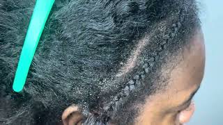 SCRATCHING UP DRY FLAKES  DANDRUFF  HAIR SCRATCHING  ASMR [upl. by Maude347]