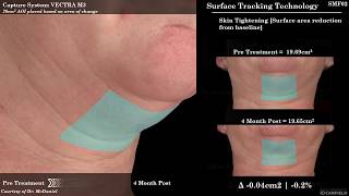 SculpSure for Submental Fat Reduction Under the Chin Fat [upl. by Sousa171]