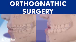 ORTHOGNATHIC surgery  All about JAW realignment surgery © [upl. by Mond]