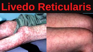 What is Livedo Reticularis Causes Treatment [upl. by Sidon]