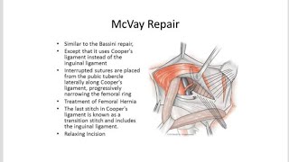 McVay Repair Surgery for Inguinal Hernia Herniorraphy [upl. by Ennovart]