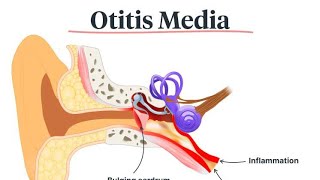 Otitis Media إلتهاب الأذن الوسطى [upl. by Assili309]