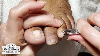 Thick Yellow Toenails Transformation Tutorial nails satisfying [upl. by Epps]