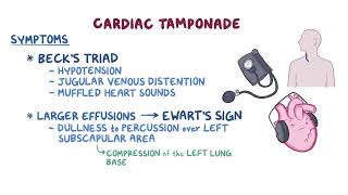 Clinical Reasoning  Pericardial Disease  Osmosis [upl. by Trout]