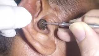 Removing MASSIVE Earwax from Mans Ear [upl. by Odrude]