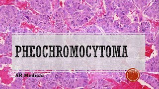 Pheochromocytoma Pathophysiology Symptoms Treatment [upl. by Underwood]