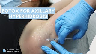 Botox for Axillary Hyperhidrosis  Melbourne Skin amp Dermatology [upl. by Colson]