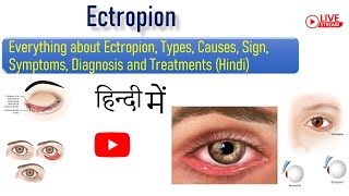 Everything about Ectropion Types Causes Sign Symptoms Diagnosis and Treatments Hindi [upl. by Pastelki411]