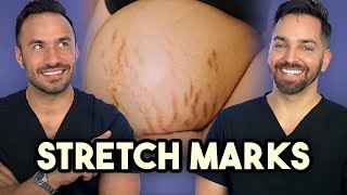 Major Announcement  How to Treat Stretch Marks like a Dermatologist [upl. by Pierre]