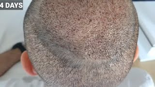 FUE Hair Transplant Timeline  Month 1 to 6  Before amp After [upl. by Nomra]