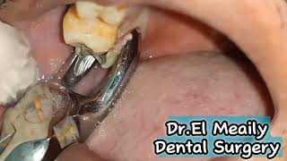 Exodontia Badly Decayed Upper Molar [upl. by Rustice]