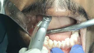 live alveoloplasty for increasing prosthetic space for lower molars replacement with implants [upl. by Nyleaj]