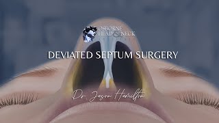 Deviated Septum Surgery [upl. by Ettigirb]