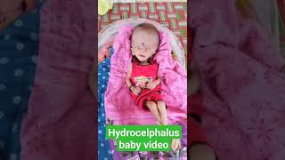 hydrocelphalus baby videohydrocephalus treatment without surgeryhydrocephalus [upl. by Ilamad]