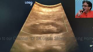 Malrotation of Kidney on Ultrasound [upl. by Yknip415]