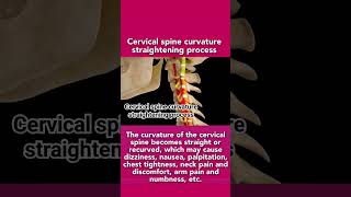 Cervical spine curvature straightening processcervical spine subscribe like shortvideo [upl. by Jdavie]